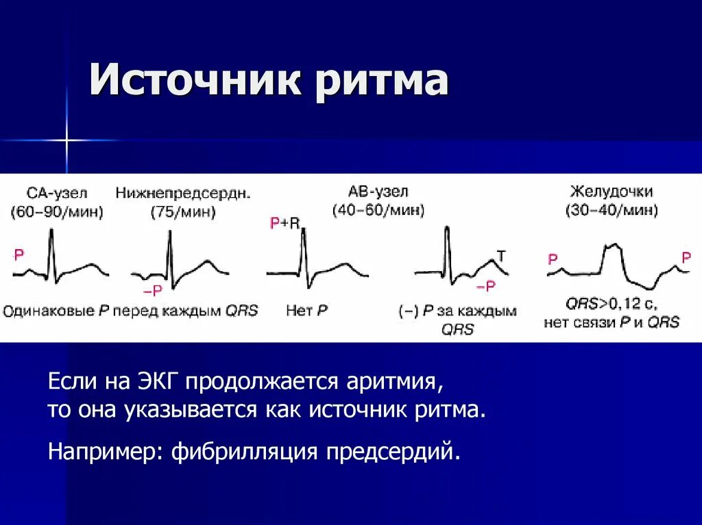 Виды ритмов на экг