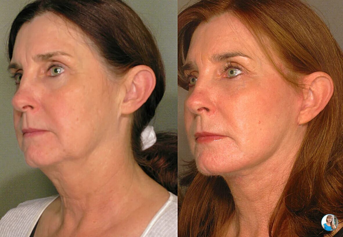 причина брылей на лице. причина брылей на лице. брыли. причина брылей на лице. брыли на лице.