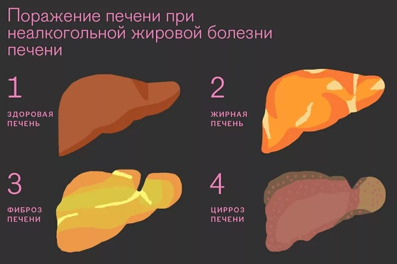 ожирение печени 2 степени. жировая инфильтрация печени. тиреотоксический гепатоз. жир печени человека. неалкогольный жировой гепатоз печени.