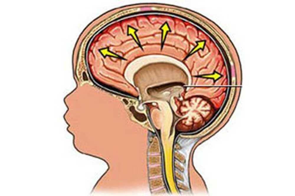 Нарушение оттока спинномозговой жидкости. Ликвор в головном мозге при гидроцефалии. Дренаж ликвора головного мозга. Шунтирование ликвора головного мозга.