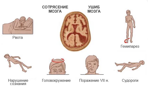 Упала сильно ударилась головой. Признаки сотрясения.