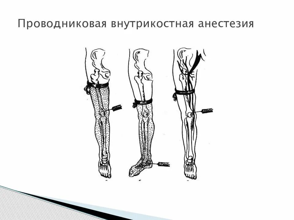 Внутрикостная блокада. Проводниковая анестезия. Местная проводниковая анестезия. Внутрикостная местная анестезия. Техника проводниковой анестезии.