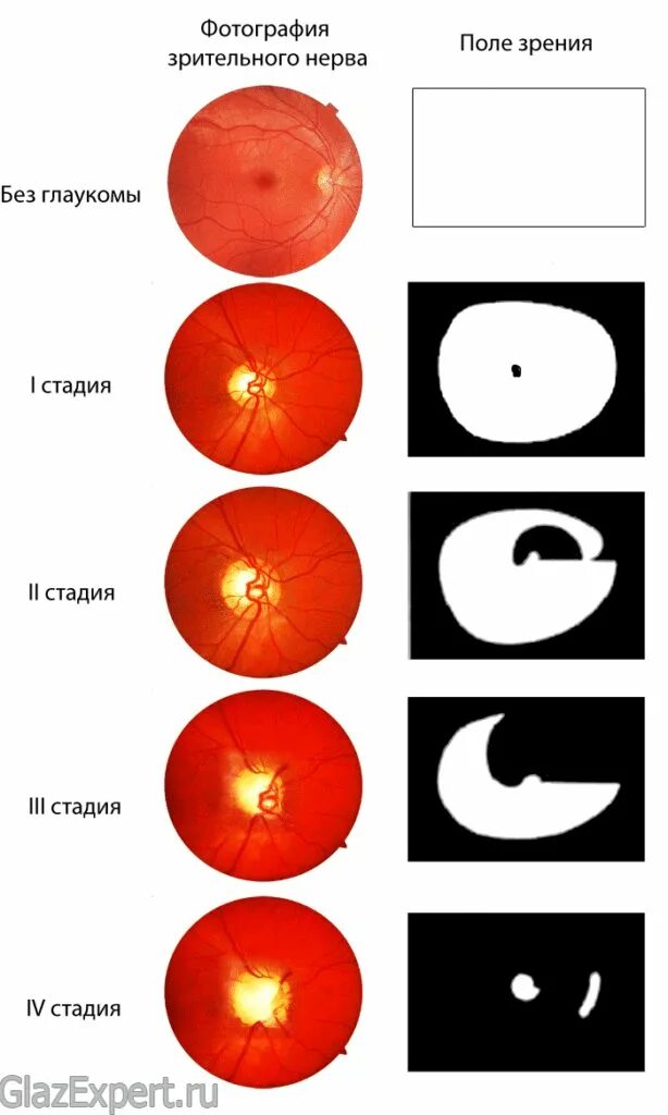 Атрофия зрительного нерва периметрия. Стадии развития глаукомы. Стадии глаукомы по периметрии. Глаукома поля зрения по стадиям. Классификация глаукомы