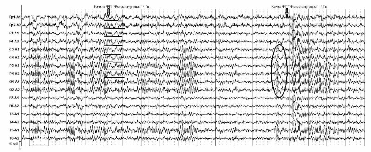 Фотопароксизмальный ответ на ЭЭГ. Фотопароксизмальная реакция при ЭЭГ. Фотопароксизмальная активность. Высокоамплитудные медленные волны на ЭЭГ. Медленные волны на ээг