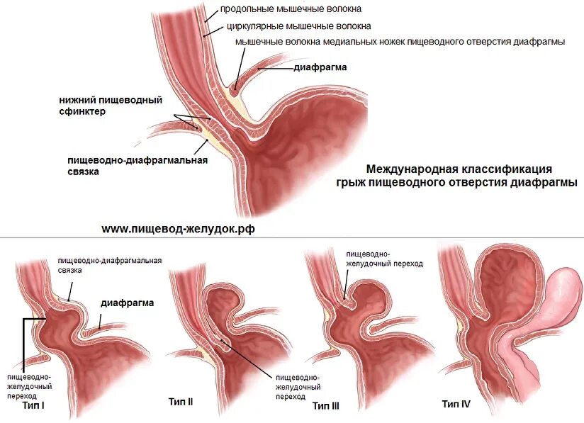 Лекарство при грыже пищевода. Протокол грыжа пищеводного отверстия. Аксиальная хиатальная грыжа. Симптомы скользящей грыжи пищеводного отверстия диафрагмы. Скользящая аксиальная грыжа пищеводного отверстия диафрагмы 2 ст.