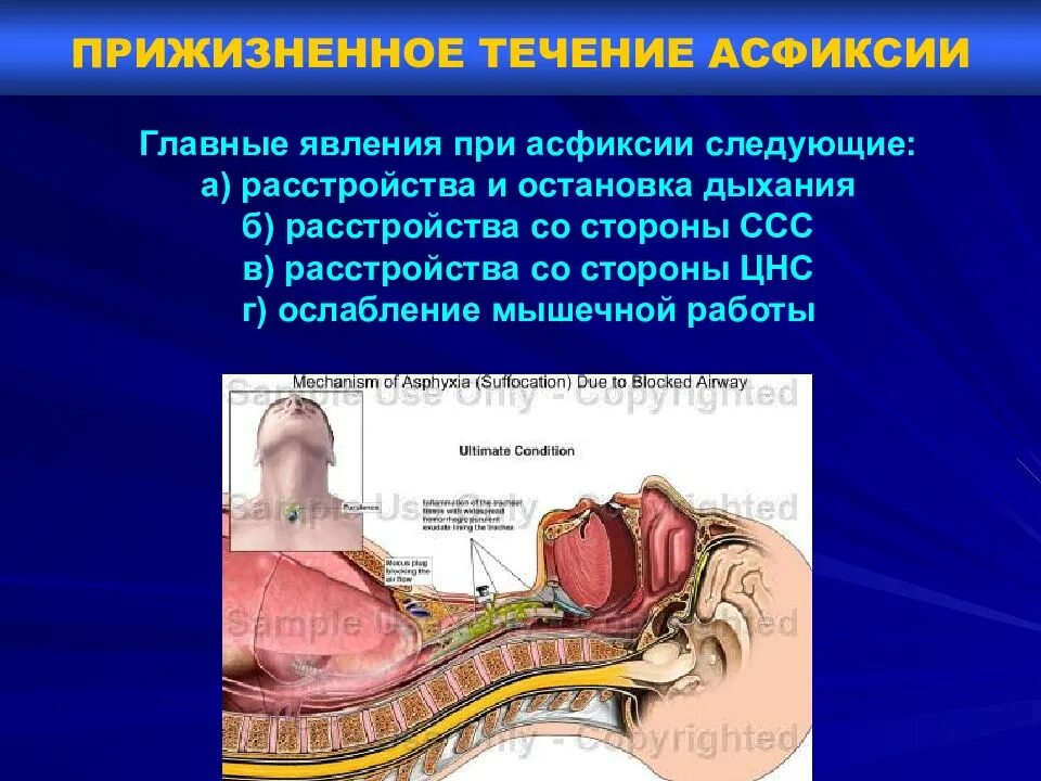 Асфиксия клиника. Компрессионная асфиксия судебная медицина. Механическая компрессионная асфиксия. Причина смерти асфиксия.