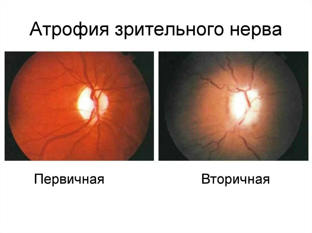 Нейропатия зрительного нерва Лебера. Первичная и вторичная атрофия зрительного нерва. Вторичная постзастойная атрофия зрительного нерва.
