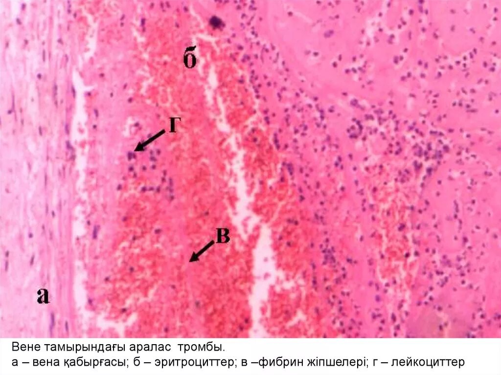 Красный обтурирующий тромб микропрепарат. Смешанный тромб в Вене микропрепарат. Смешанный тромб артерии микропрепарат. Пристеночный тромб гистология. Пристеночный тромбоз