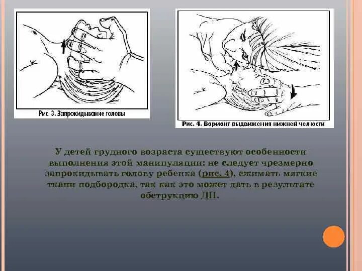 Запрокидывание головы ребенка. Ащдктый живот у новорожденного. Запрокидывание головы у грудничка. Запрокидывание головы ребенка. Запрокидывание головы ребенка.