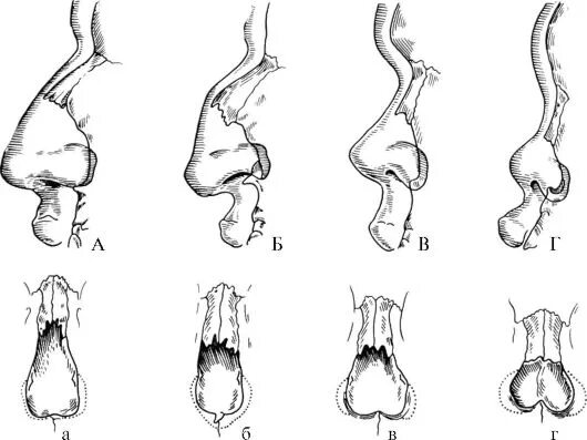Формы носа. Анатомическая форма носа. Патологические формы носа.