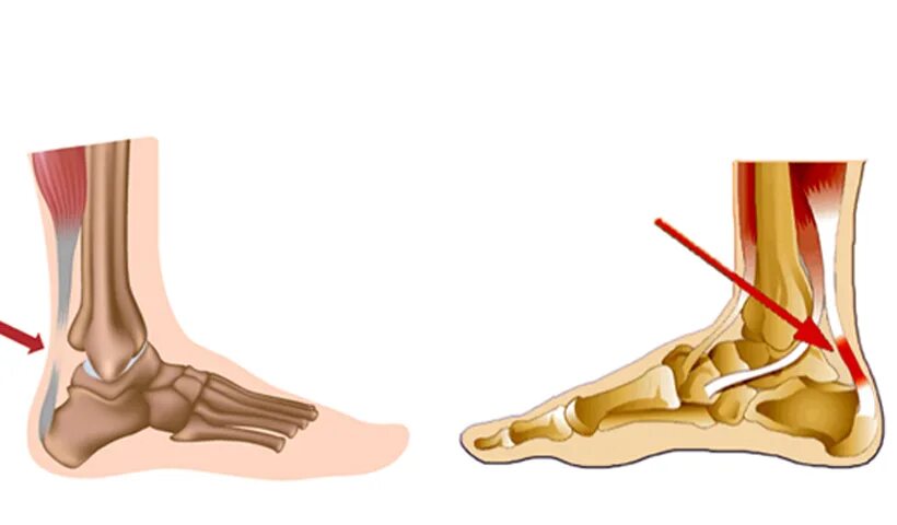 Слабость ахиллесова