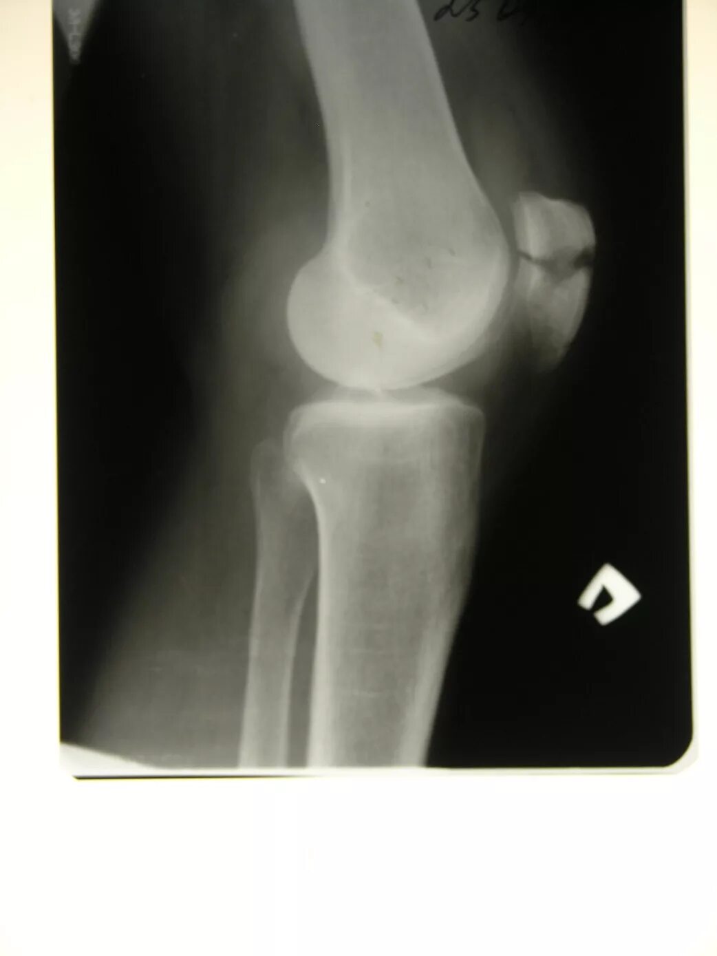 Перелом надколенника остеосинтез. Перелом коленной чашечки рентген. Перелом надколенника и остеосинтез по Веберу. Металлоостеосинтез перелома надколенника.