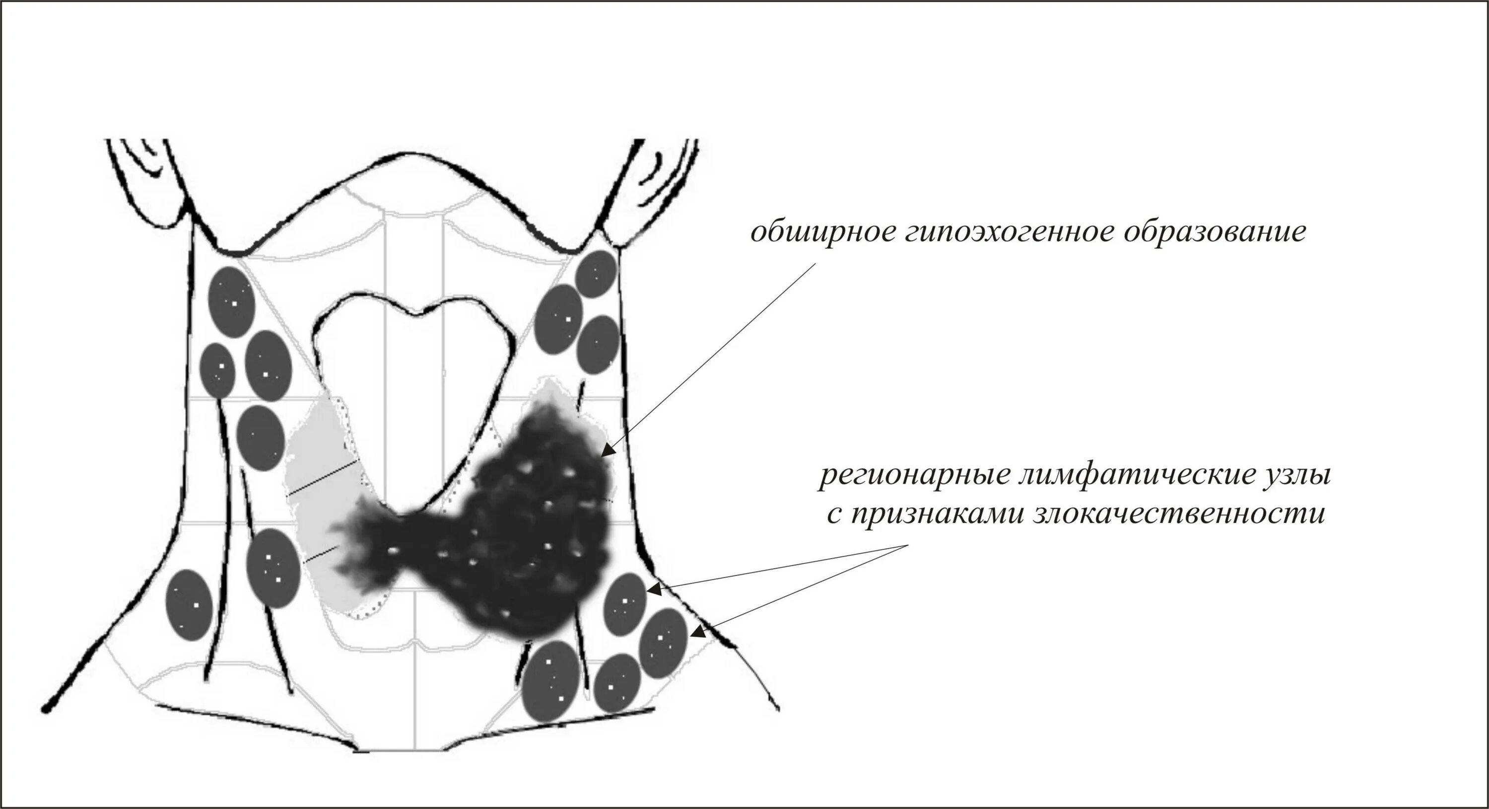 Регионарные лимфатические узлы щитовидной железы на УЗИ. Региональные лимфатические узлы щитовидной железы. Регионарные лимфатические узлы. Регионарные лимфоузлы щитовидной железы. Щитовидная железа узи лимфоузлы