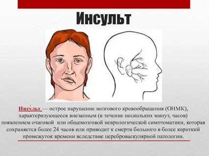 Ударение в слове инсульт
