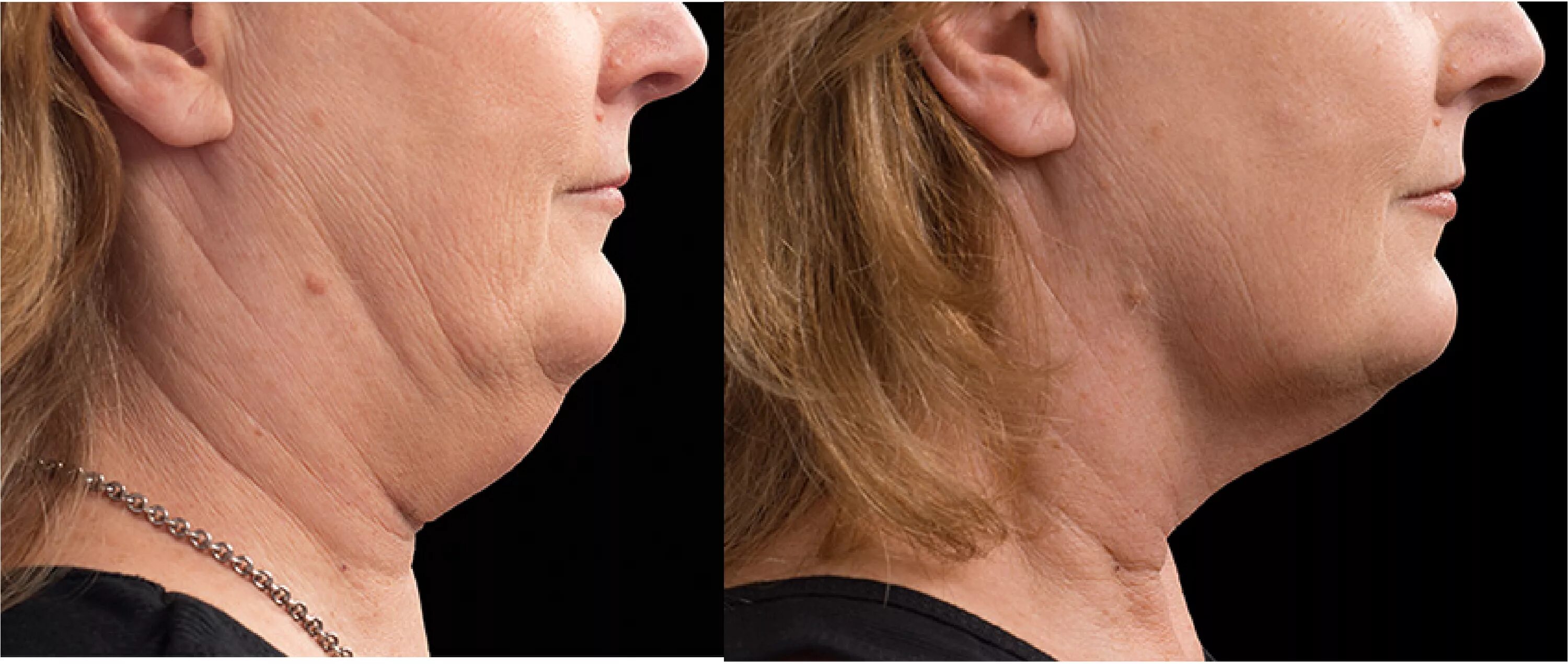 упражнения от второго подбородка. тяжи платизмы второй подбородок. второй подбородок у женщин. осанка и 2 подбородок. второй подбородок.