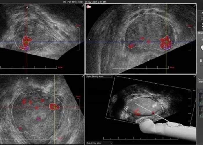 Биопсия рак простаты. Трансректальная биопсия простаты. Трансректальная мультифокальная биопсия предстательной железы. Пункционная биопсия простаты. Биопсия карциномы предстательной железы.