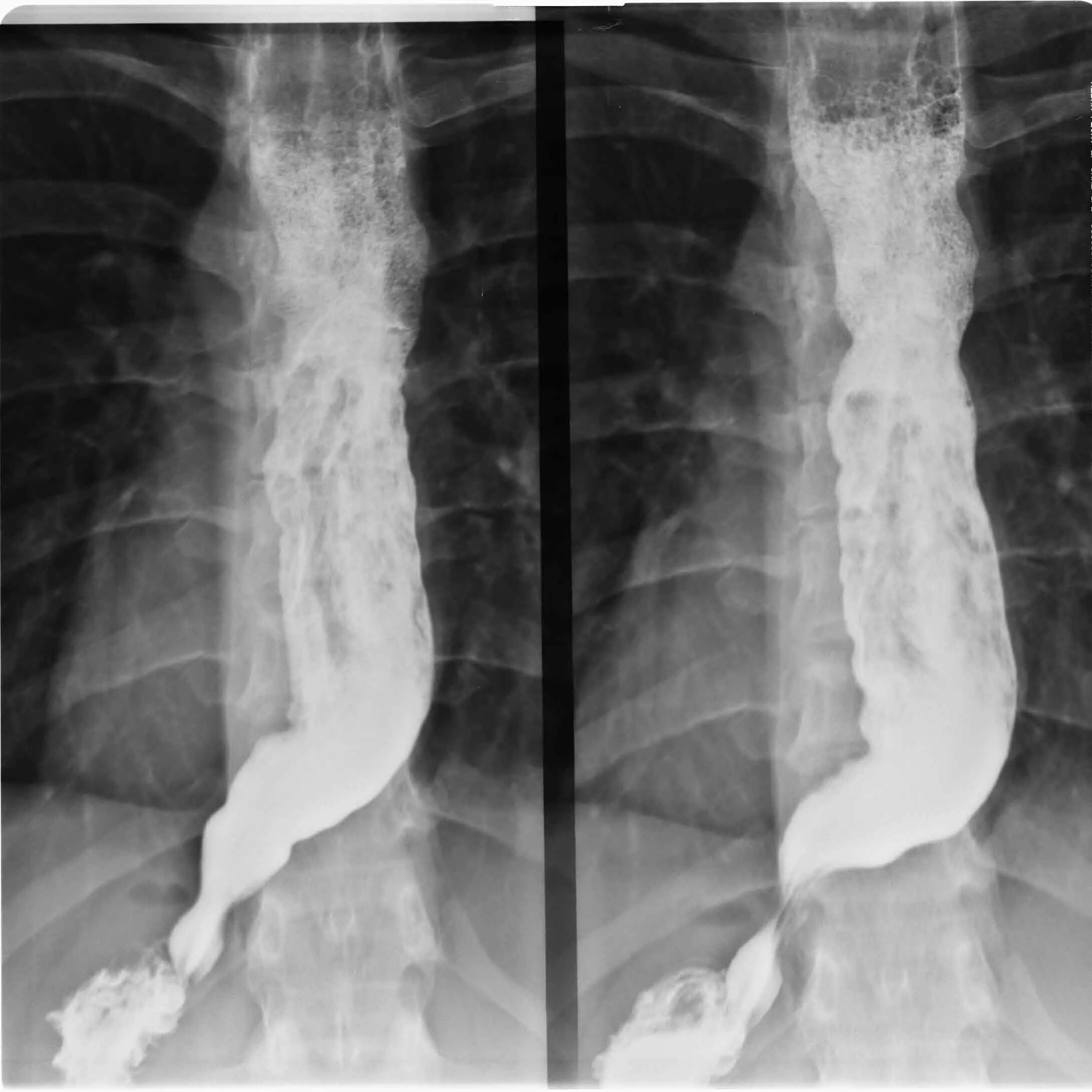 Ахалазия пищевода рентген. Ахалазия кардии пищевода рентген. Кардиоспазм пищевода рентген. Ахалазия пищевода рентгенодиагностика.