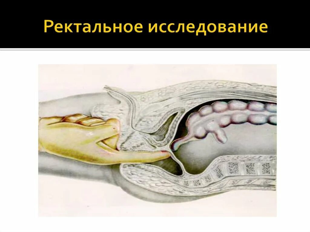 Ректальный метод. Бимануальное ректальное исследование. Пальцевое исследование прямой кишки у детей. Прямокишечное двуручное исследование. Ректальное исследование в акушерстве.