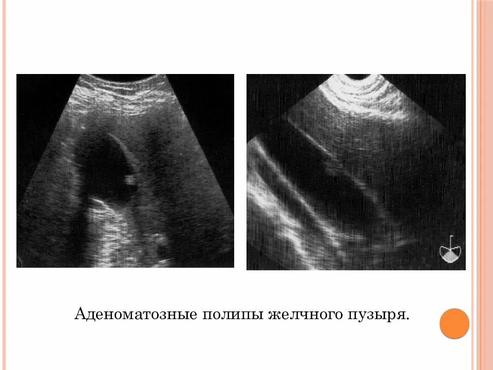 Какие полипы желчного пузыря. Полип желчного пузыря на узи. полипоз желчного пузыря на узи. полим желчно пузыря узи. ультрасонография желчного пузыря полип.
