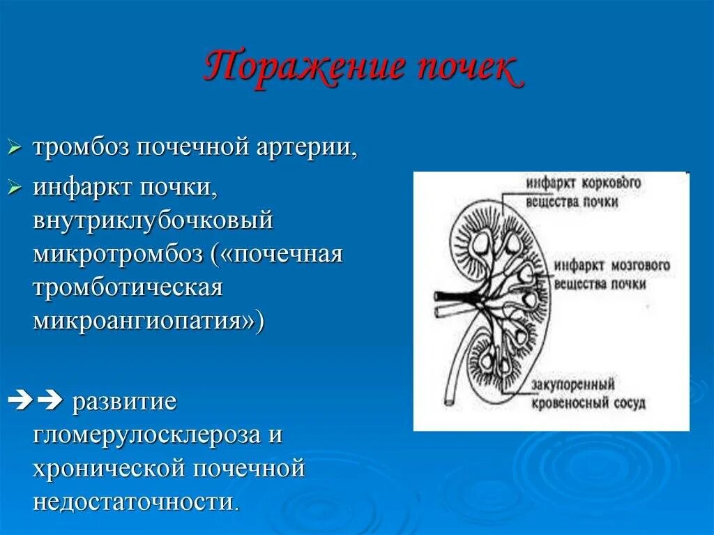 Поражение почечных артерий. Тромбоз почечной артерии гистология. Тромбоз почечной артерии