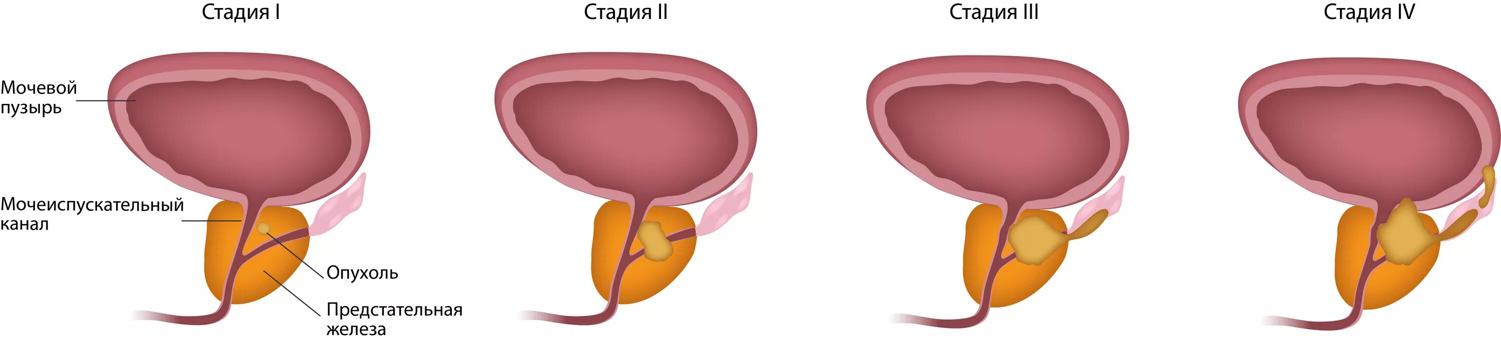 Простата форма. Аденома предстательной железы – это опухоль. Аденома карцинома предстательной железы. Тумор предстательной железы. Этапы развития онкологии простаты.