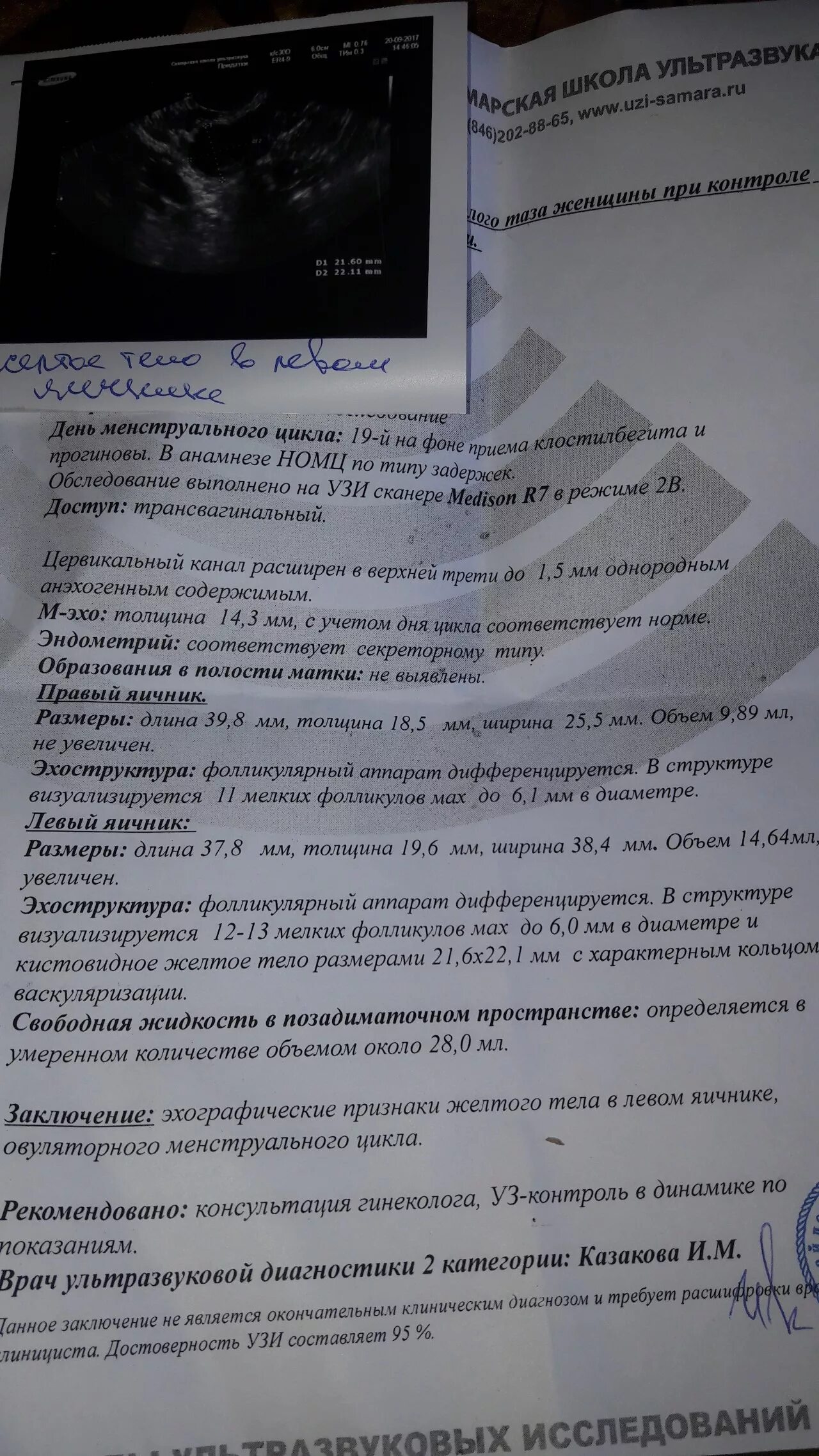 Узи овуляции форум. Свободная жидкость в Малом тазу. Жидкость в позадиматочном пространстве на УЗИ заключение.