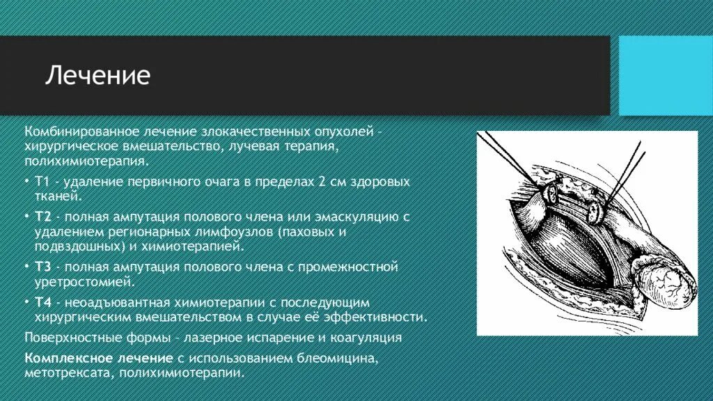 Придатки у мужчин симптомы. Опухоли яичка презентация. Иссечение в пределах здоровых тканей это.