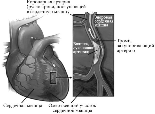 Коронарография стеноз. Миокардиальные мостики коронарных артерий. Коронарография сосудов стентирование. Коронарные мостики. Коронарные мостики.