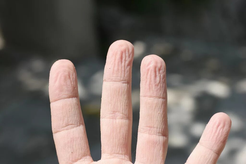 Почему пальцы можно. Сморщенная кожа на пальцах рук.