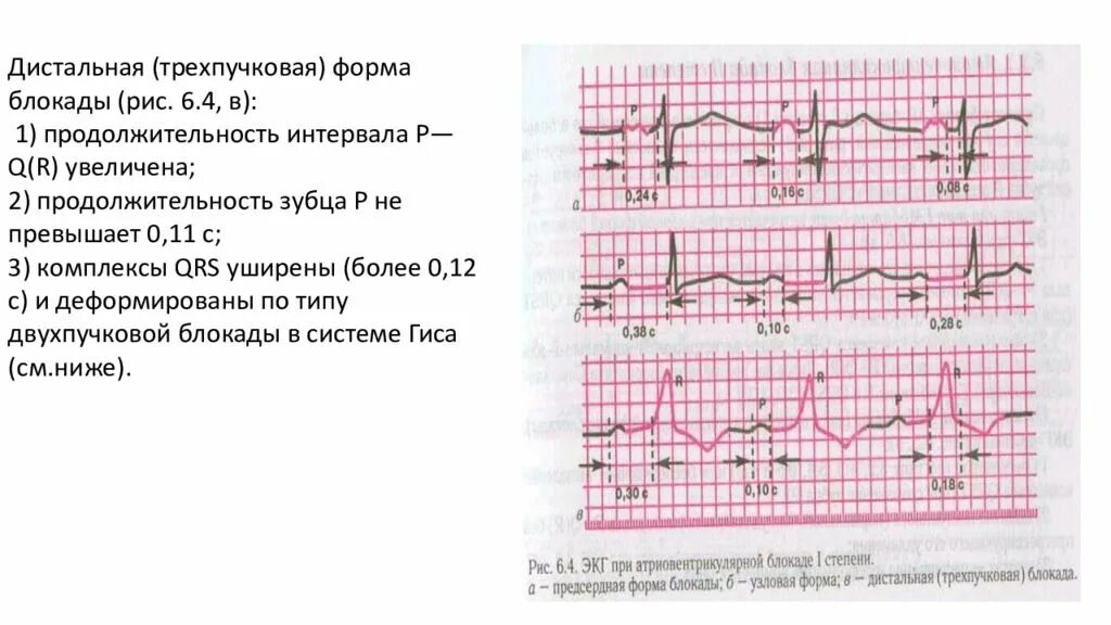 Блокада qrs. Трехпучковые блокады ножек пучка Гиса на ЭКГ. Трехпучковая блокада на ЭКГ. Трехпучковая блокада ножек пучка Гиса на ЭКГ. Трехпучковая блокада признаки на ЭКГ.