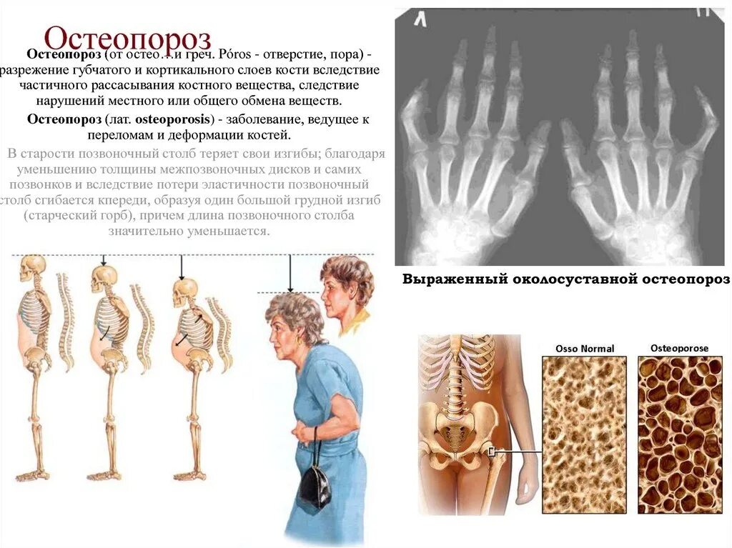 Нарушение плотности костей