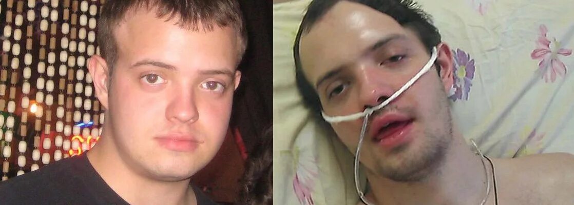 Парень остался инвалидом. Парень заступился за девушку. в саранске зарезан мужчина.