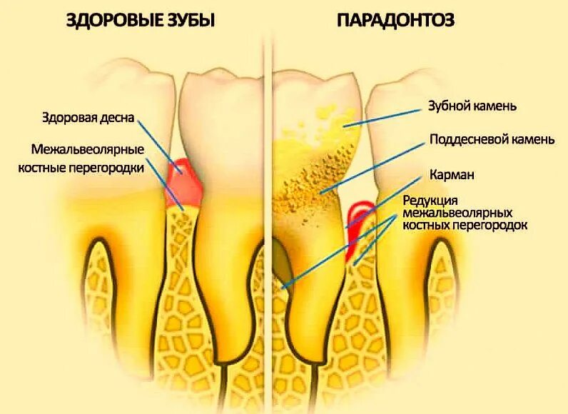 Оголение зубного корня.