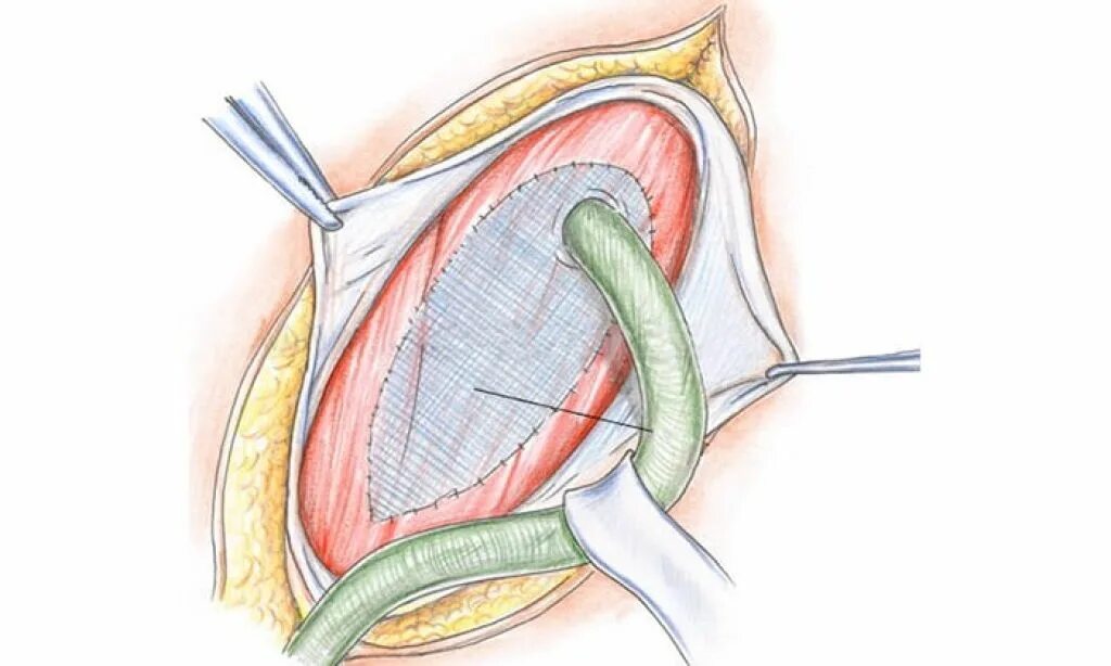 Герниопластика послеоперационной грыжи живота. Операция грыжесечение пупочной грыжи. Герниопластика бедренной грыжи. Операция грыжесечение паховой грыжи. Сетка для операции на грыжу