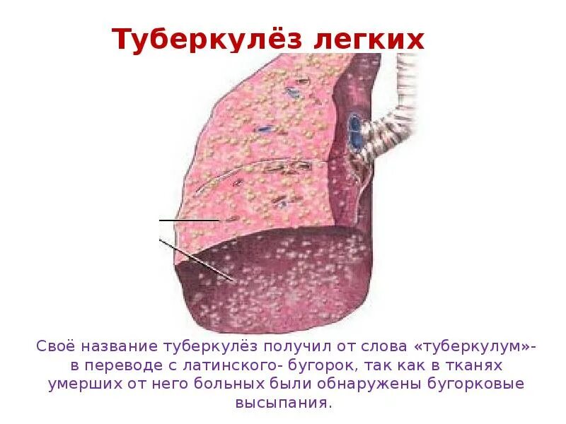 Туберкулез презентация. Туберкулез легких презентация. Бугорок при туберкулезе.