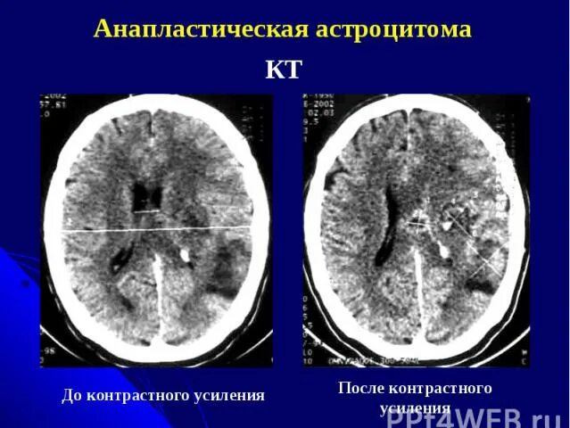 Астроцитома головного мозга прогноз после операции. Анапластическая астроцитома гистология. астроцитома лобной доли мрт. анапластическая астроцитома мрт.