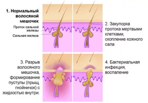 Фолликулит системная терапия. Фолликулит кожи волосистой части головы. Воспаление волосяной луковицы. Воспаление волосяного мешочка.