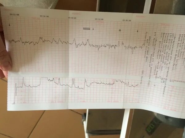 Подозрительное ктг. Подозрительное ктг