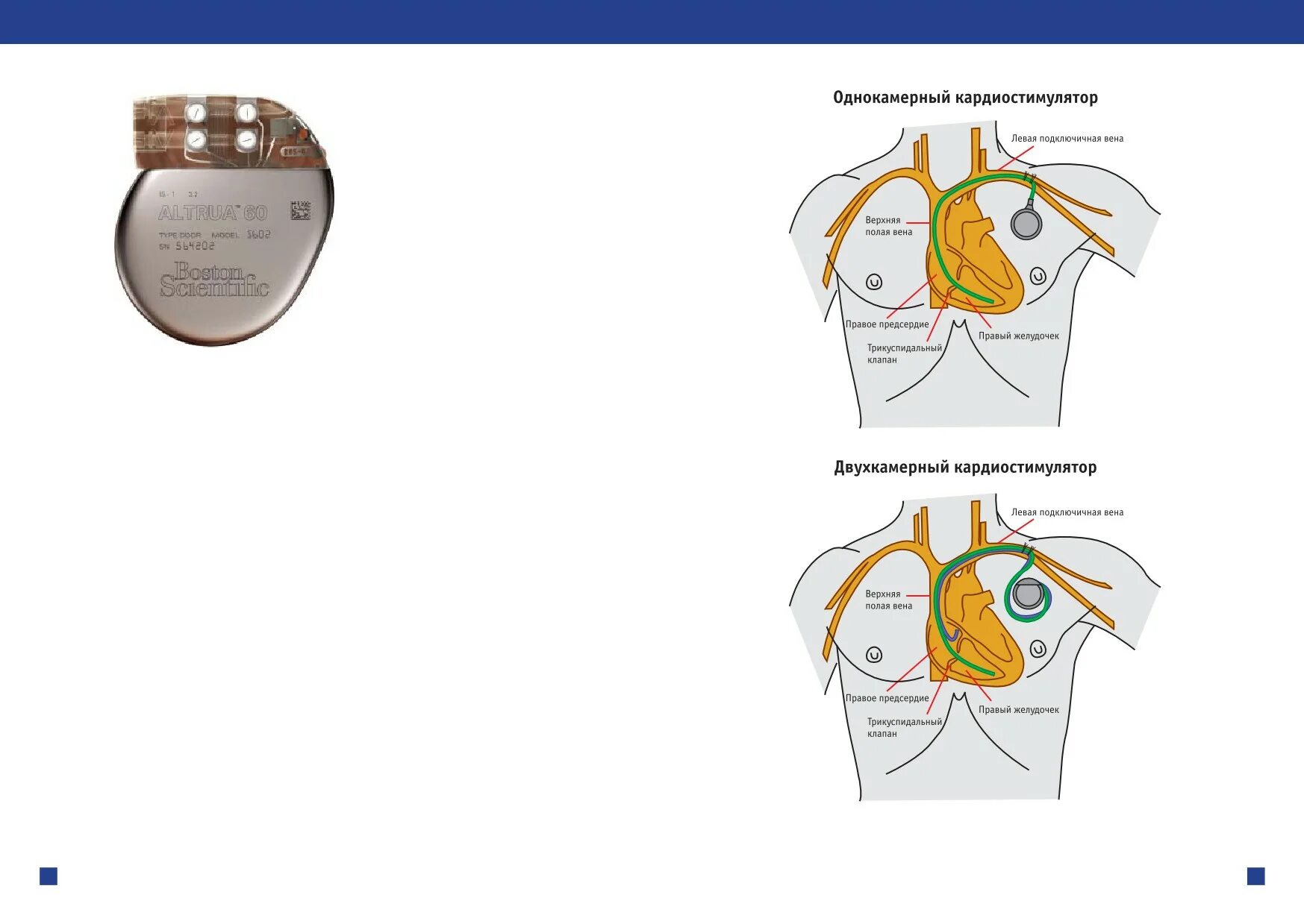 Кардиостимулятор сердца установленный. Однокамерный кардиостимулятор. Схема установки кардиостимулятора. Двухкамерный внешний кардиостимулятор. Почему в инструкции людям с кардиостимуляторами запрещается
