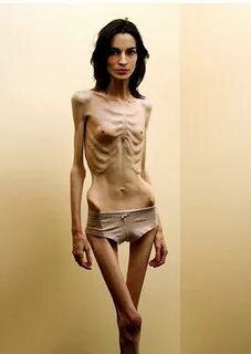Extremely Skinny Naked Women.