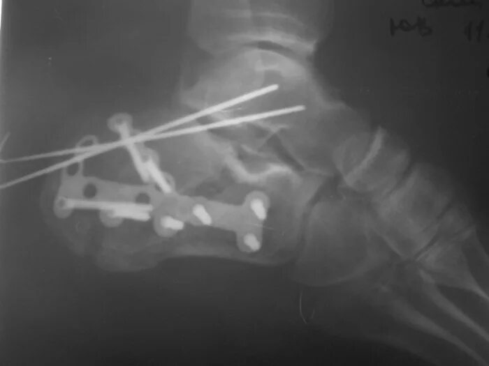 Перелом со смещением нужна операция. Операция остеосинтез пяточной кости. Перелом пяточной кости операция. Остеосинтез пяточной кости спицами. Перелом пяточной кости остеосинтез.