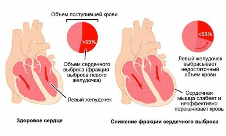 Повышенный сердечный выброс. Левый желудочек сердца фракция выброса норма. Сниженная фракция выброса левого желудочка. Уменьшение фракции выброса в сердце. Фракция выброса левого желудочка 30.