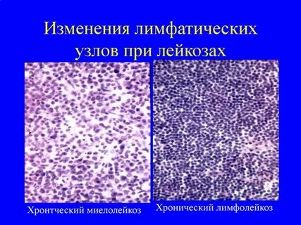 Изменение лимфатического узла