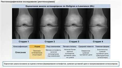 Остеоартроз 1 степени коленного сустава это что