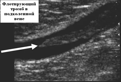 Тромб в вене узи