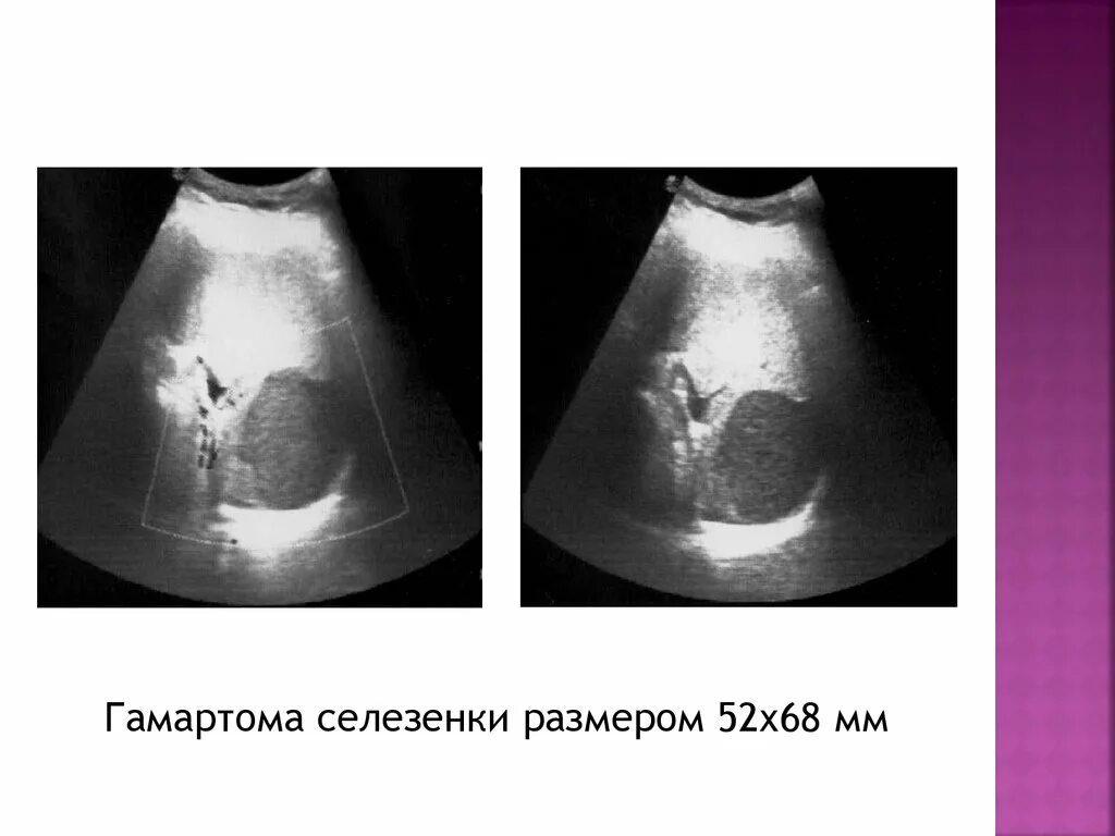 Ультразвуковая диагностика патологии селезенки. Гамартомы селезенки кт. Гамартома селезенки на УЗИ. Паразитарная поражение селезенки.