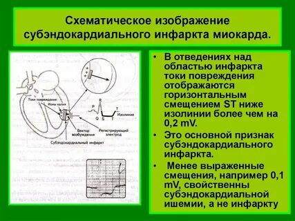 Субэндокардиальный инфаркт