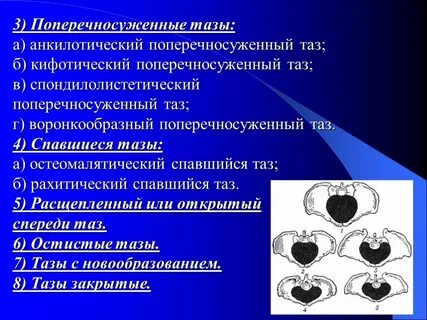 Поперечносуженный таз