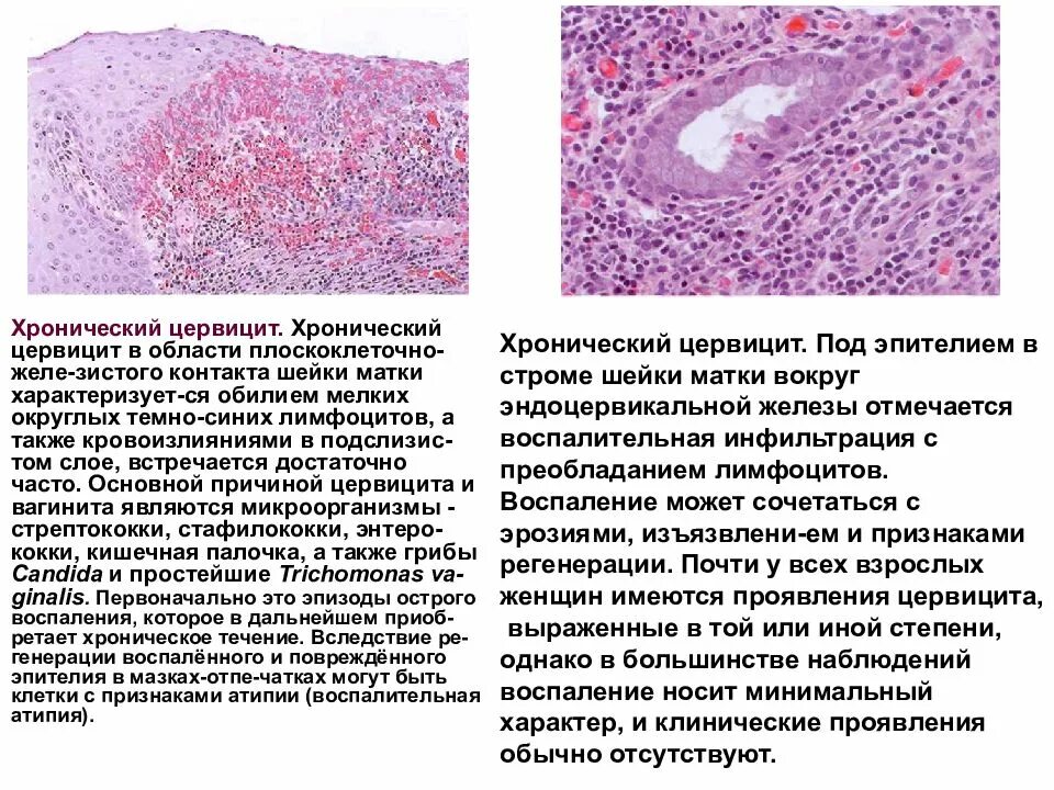 Цервицит что это у женщин причины. Хронический цервицит гистология. Строма шейки матки гистология. Хронический эндоцервицит гистология. Карцинома эндометрия макропрепарат.