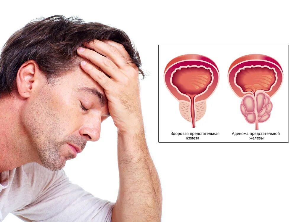 Воспаление семенного мужчин. Аденома предстательной железы. Аденома предстательной железы симптомы. Аденома предстательная железа у мужчин.